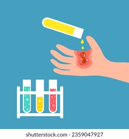 Chemical acid burn on hand skin in flat design. Injured palm skin.