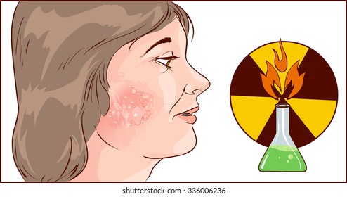chemical burns to face