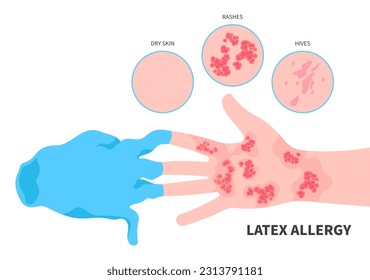 chemical exposure latex allergy the allergic itching around finger arm wrist health care and wear gloves natural pain skin rash and Hives dermatitis with tree dry infection