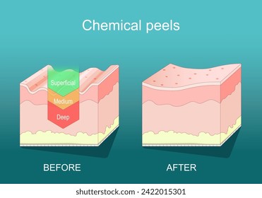 Chemical peel. Beauty aesthetic treatment. Deep, medium, Superficial peel. Dermatological procedure for Skin rejuvenation. Exfoliation. Cross section of human skin. isometric flat vector illustration