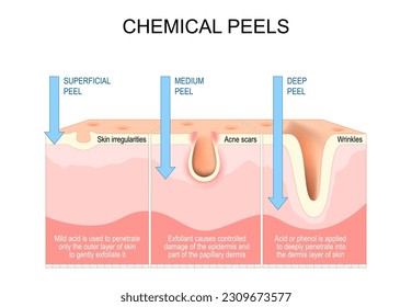 Chemical peels. Exfoliation. rejuvenation of face for Wrinkles, and Acne scars. Treatment of skin irregularities, hyperpigmentation. Cross section of a human skin. Vector illustration