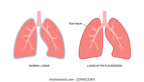 Afiche médico de pleurodesis química. Trata las effusiones pleurales malignas inyectando una sustancia química en la cavidad pleural. Tejido cicatrizado en el espacio pleural. Ilustración vectorial plana de enfermedades pulmonares