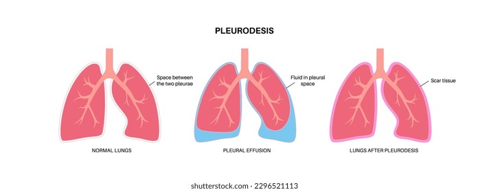 Chemical pleurodesis medical poster. Treats malignant pleural effusions by injecting a chemical substance into the pleural cavity. Scar tissue in pleural space. Lung diseases flat vector illustration