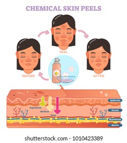 Chemical skin peels vector illustration diagram with 3 steps and skin layer scheme. 