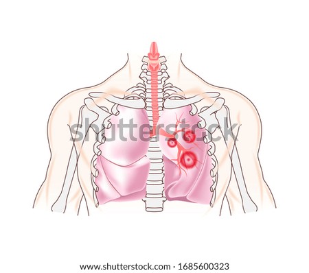 The chest is anatomically correct with lungs affected by the disease. Pneumonia Covid-19. Vector illustration realistic isolated.