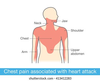 Chest pain associated with heart attack. Medical illustration and info graphic