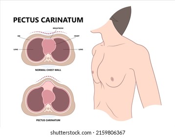 Chest wall disorder Pectus ribs sunken funnel heart murmur lung COPD pain gene birth barrel Marfan Ehlers Danlos Noonan Turner head Xray thorax muscle brace sport injury Pleural effusion asthma