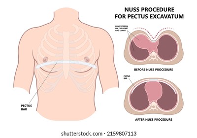 Vor und nach der Operation Anatomie der Brust, die Metallstab eingesetzt, um die Immobilie zwischen Brustbein zu bremsen das medizinische Verfahren