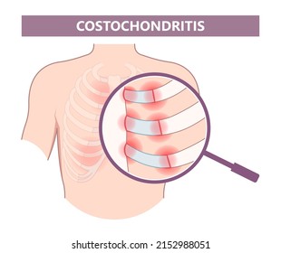 Chest Wall Muscle Rib Fracture Broken Acute Pain Tietze Syndrome Bone Joint Tract  Deep Breath Or Cough Strain Virus Bacteria Tumor Cancer Overuse