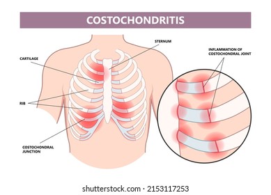 chest wall muscle rib fracture broken acute pain tietze syndrome bone joint tract  deep breath or cough strain Virus bacteria Tumor Cancer overuse