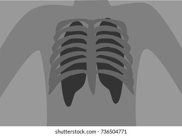 Chest Xray Illustration Stock Vector (Royalty Free) 736504771 ...