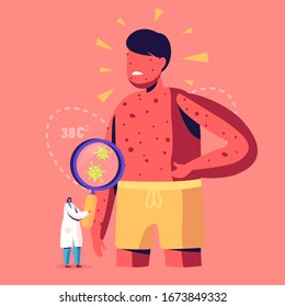 Chicken Pox Varicella Symptoms Concept. Tiny Doctor Character with Magnifying Glass Looking on Germs at Huge Boy with Red Pimples on Body. People Vaccination, Immunization. Cartoon Vector Illustration