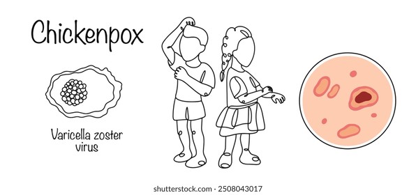 Chickenpox. An acute, highly contagious viral disease with airborne transmission. Children with a rash on the body that is very itchy. Vector illustration.