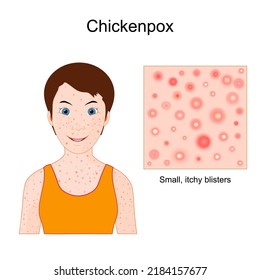 Chickenpox. Varicella. face of a child with skin rash. Close-up of skin with small, itchy blisters. Vector poster