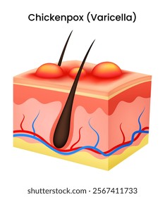 Chickenpox (Varicella zoster virus) Vector Illustration