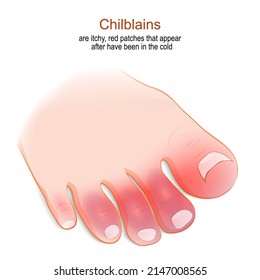 Chilblains are itchy, red patches that appear after have been in the cold. Humans foot with red or swollen toes. vector illustration