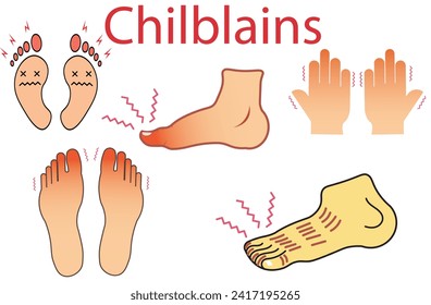 chilblains,Medical illustrations of the toes afflicted with chilblains,Chilblains are itchy, red patches that appear after have been in the cold. Humans foot with red or swollen toes. vector 