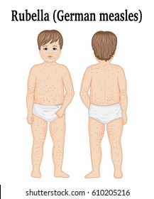 A Child In A Diaper Suffering From Rubella (German Measles) In Two Angles