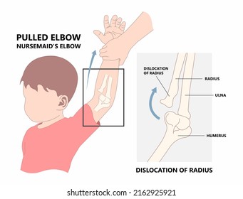 Child Elbow Dislocated Injury That Cause Ulna Bone Fracture Nursemaid Painful Head Of Radius Subluxation Young Slight Bend