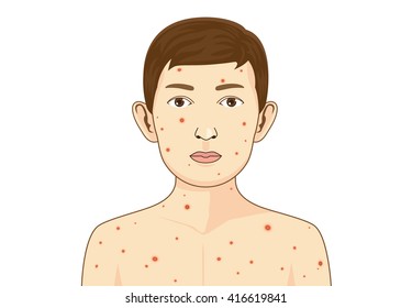 Child get chickenpox disease. He has an itchy rash and red spots or blisters.