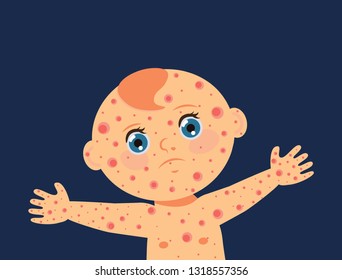 Child Ill With Measles, Chicken Pox, Vippa, Rubella From Rash All Over The Body, Vector Illustrations