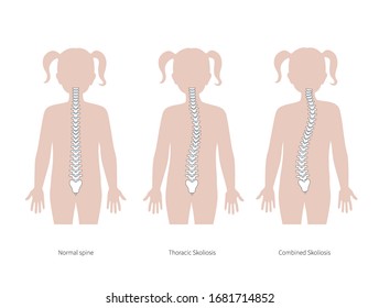 Child scoliosis flat vector illustration. Types of scoliosis of spine infographics. Diagram of girl spine curvatures and healthy. Body posture defect. Medical, educational and science banner