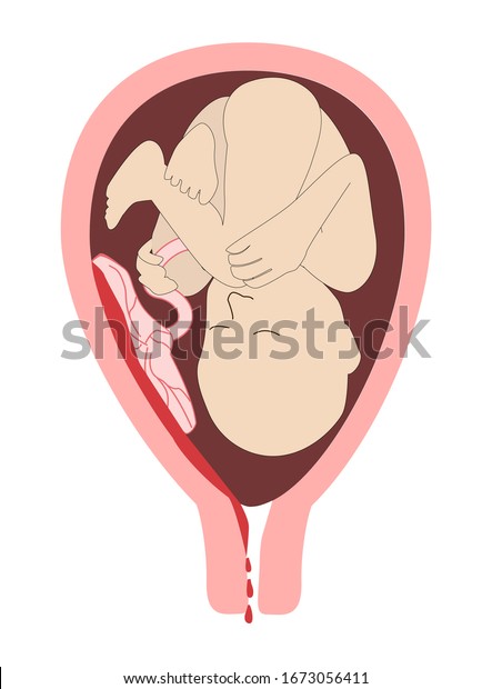 胎内の子 胎盤剥離 胎盤剥離 膣出血 妊娠の危険な合併症や流産の恐れ ベクターイラスト のベクター画像素材 ロイヤリティフリー