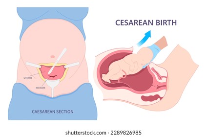 Childbirth Delivery Caesarean C section newborn Baby birth prolapse umbilical cord twins scar womb tummy women infant Fetal fetus mother belly Labour feet pain born medical