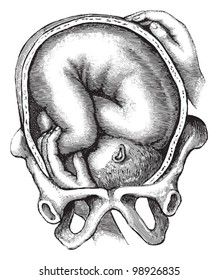 Childbirth / vintage illustration from Die Frau als hausarztin 1911