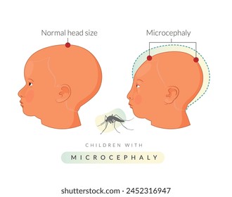 Children with microcephaly - Zika Virus - Stock Illustration as EPS 10 File