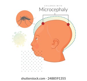 Children with microcephaly - Zika Virus - Stock Illustration as EPS 10 File