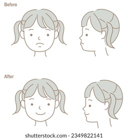 Children's faces with opposite occlusion, before and after orthodontic treatment