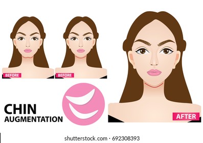 chin augmentation before and after vector illustration
