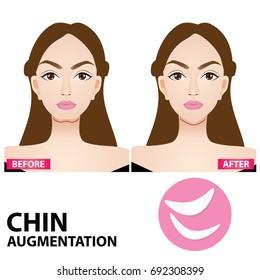 chin augmentation before and after vector illustration