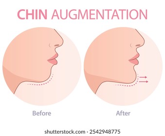 Diagrama de aumento do queixo. Cirurgia plástica de Jawline. Cirurgia ortognática.