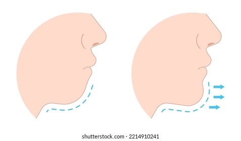 chin augmentation with rhytidectomy Orthodontist Temporomandibular joint Orthodontic double long Dermal facial nose reshaping contour grafting