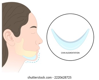 chin augmentation with rhytidectomy Orthodontist Temporomandibular joint Orthodontic double long Dermal facial nose reshaping contour grafting