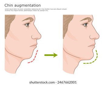 Chin augmentation surgery illustration. Contour of the chin area before and after. Plastic surgery medical illustration.