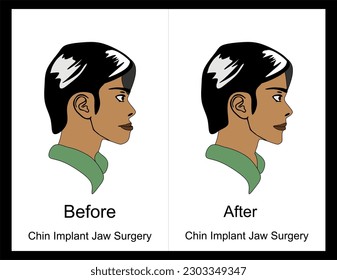 Chin Implant Jaw Surgery. Plastic Facial Cranio TMD TMJ Joint Overbite Teeth Teeth Birth Defect Open Bite Pain Cosmetic Trauma Gummy Smile Bone Reconstructive Bad