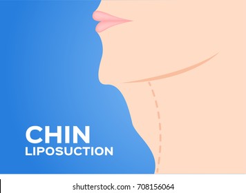 Chin Liposuction before and after , fat , cosmetic skin