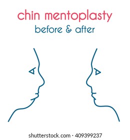 Chin mentoplasty modern vector style.