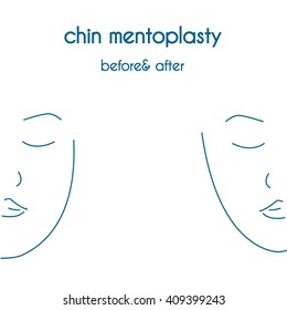 Chin mentoplasty modern vector style.