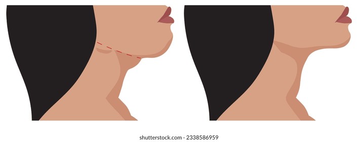 Chin reduction augmentation double chin removal plastic surgery cosmetic operation concept.