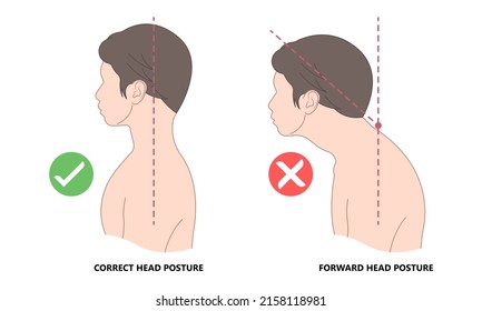Vorwärts-Kopf-Haltung schlechte Position, die zu Schulter-und Nackenschmerzen führen kann
