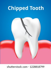 Chipped tooth with Inflamed gum, Dental care concept, Realistic design illustration Vector.