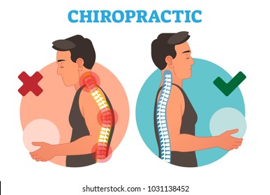 Chiropractic conceptual vector illustration with back bone curvature. Healthy and deformed. 