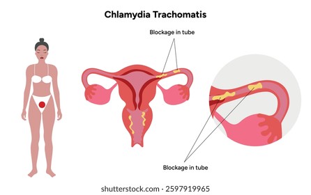 Chlamydia Trachomatis. Woman’s and man's reproductive system infections. Medical disease 
