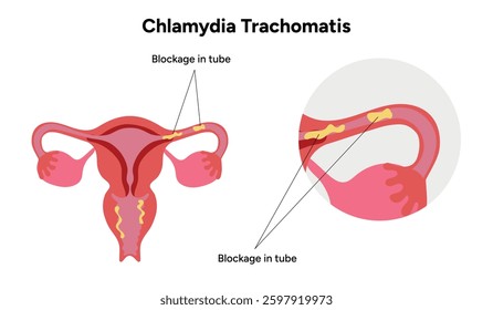 Chlamydia Trachomatis. Woman’s and man's reproductive system infections. Medical disease 