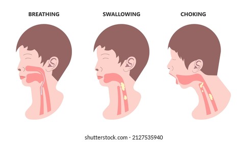 Choking first aid baby food CPR child step lodges blocking victim adult help abdomen kids conscious poster swallow back blows chest rescue breath care safety