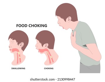 Comida agigantada con anatomía respiratoria que causa dificultad para tragar síntomas